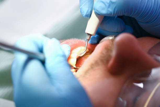 Best Emergency Root Canal Treatment in Lawrenceville, GA