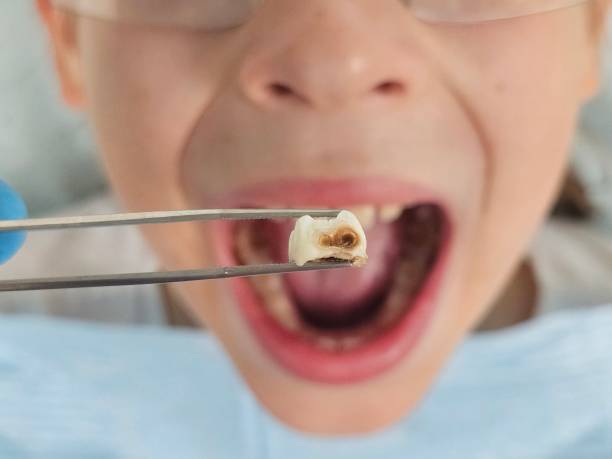 Best Emergency Dentist for Special Needs Patients in Lawrenceville, GA